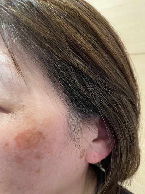 シミに悩む女性